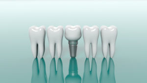dental implants Tulsa