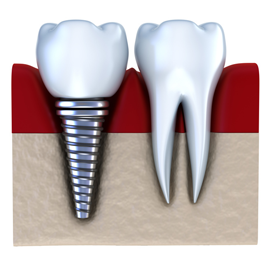 Howl Dental Tulsa | Dental Implants